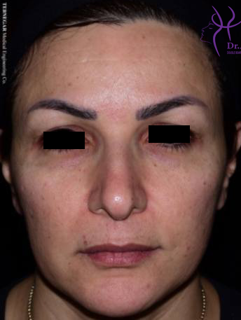 لیفت-شقیقه copy